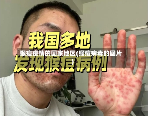 猴痘疫情的国家地区(猴痘病毒的图片)